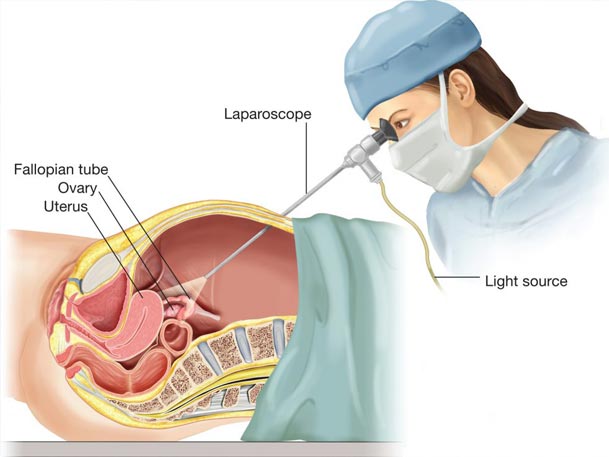 جراحی لاپاراسکوپی زنان