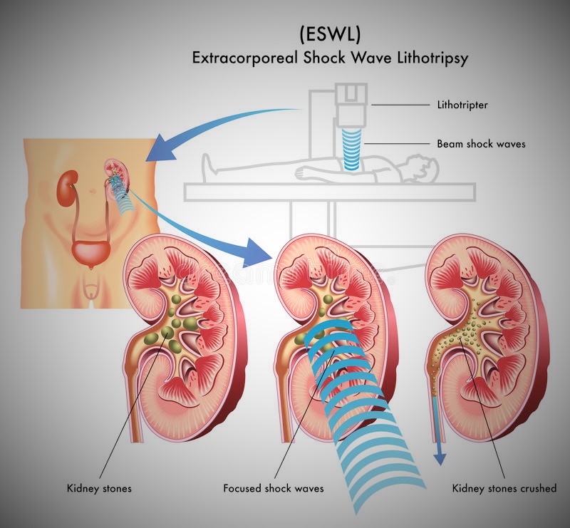 سنگ شکنی برون اندامی عمل ESWL