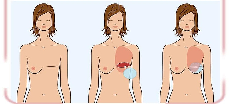 ماستکتومی - 5 نوع جراحی برداشتن سینه در سرطان پستان