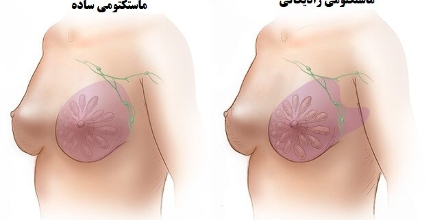 ماستکتومی - 5 نوع جراحی برداشتن سینه در سرطان پستان