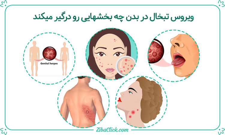 آیا تبخال تناسلی از طریق استخر منتقل می شود/ انتقال تبخال تناسلی از زن به مرد