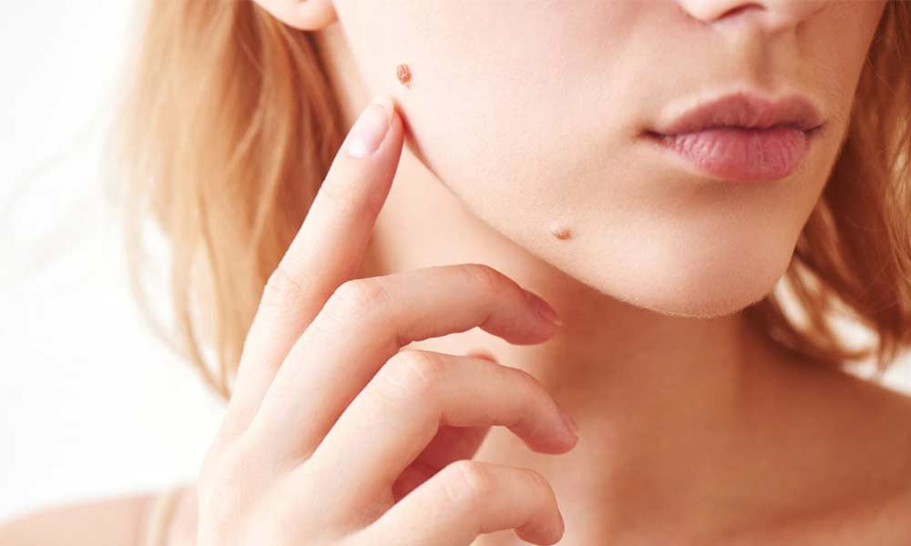 عکس زگیل صورت + انواع زگیل صورت + درمان