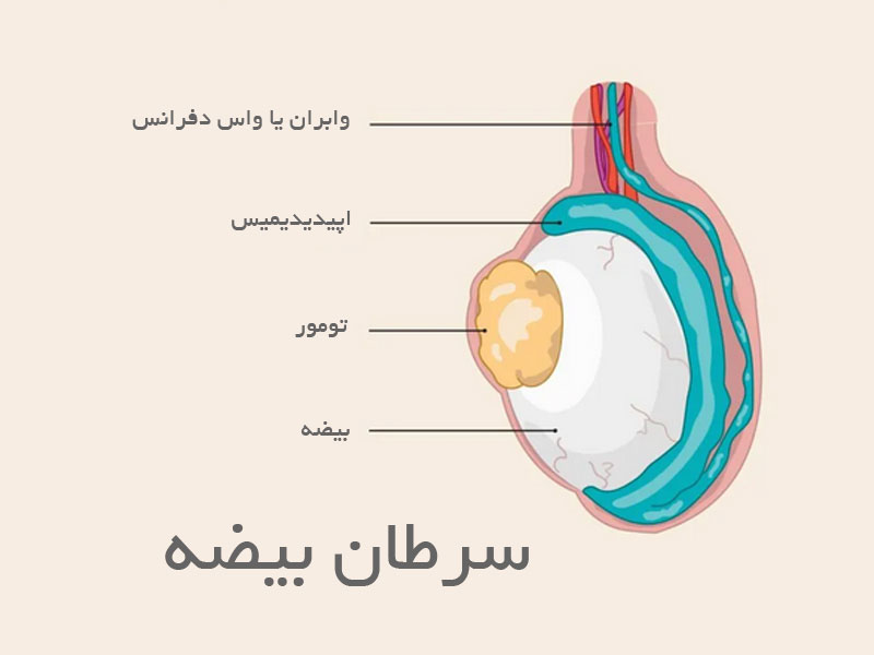 تفاوت کیست و سرطان بیضه
