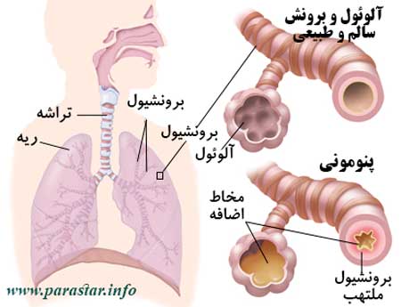 بیماری پنومونی